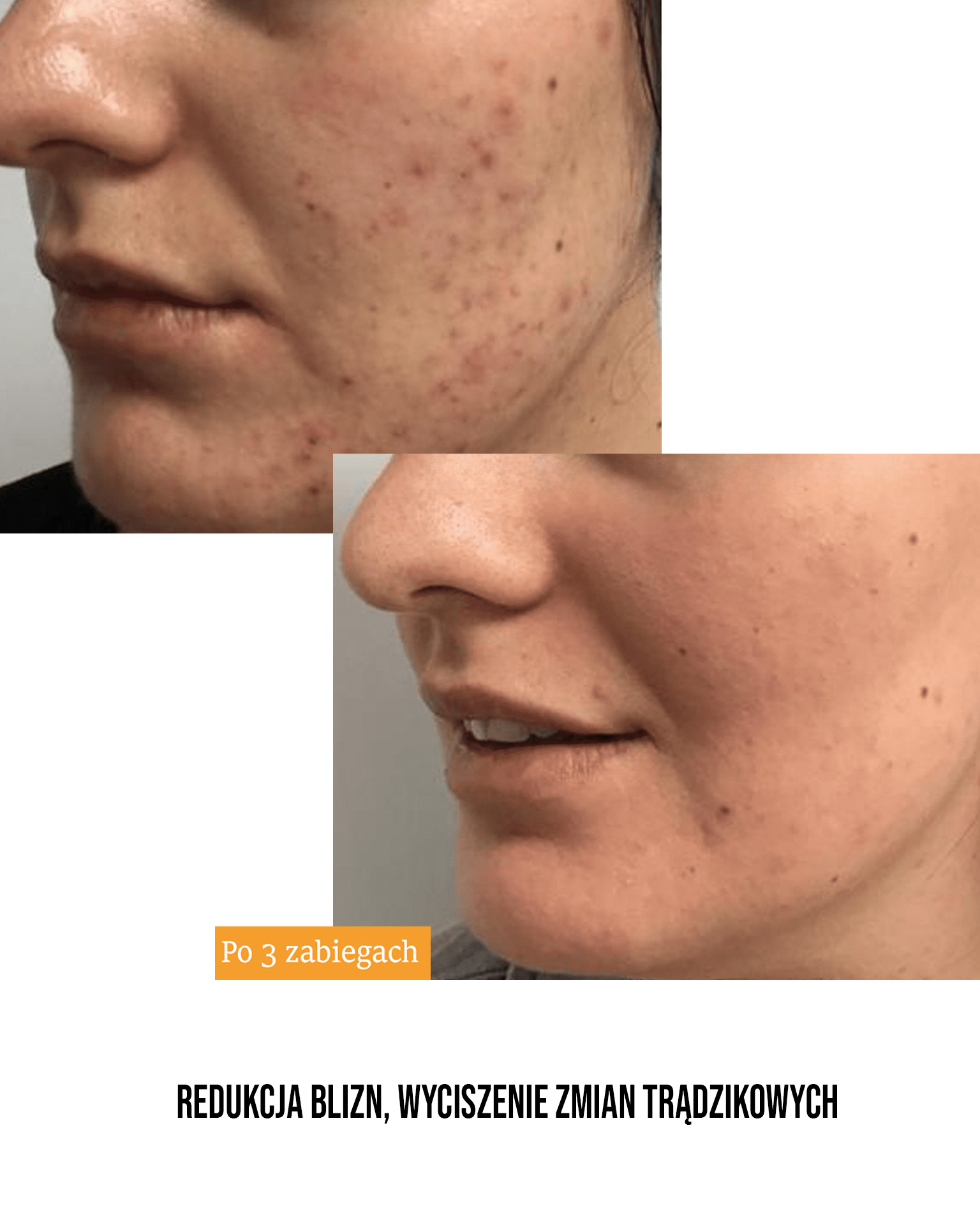 Przed i po zabiegu Tixel - przykład 1