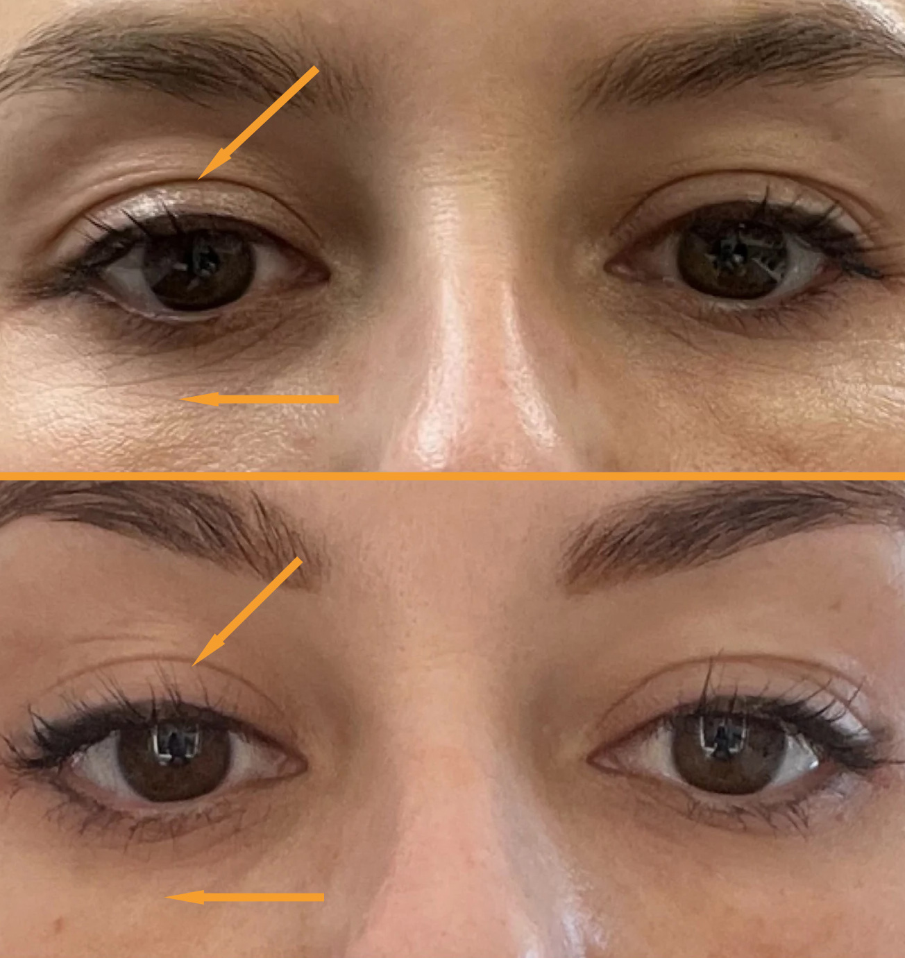 Przed i po zabiegu Tixel - przykład 10