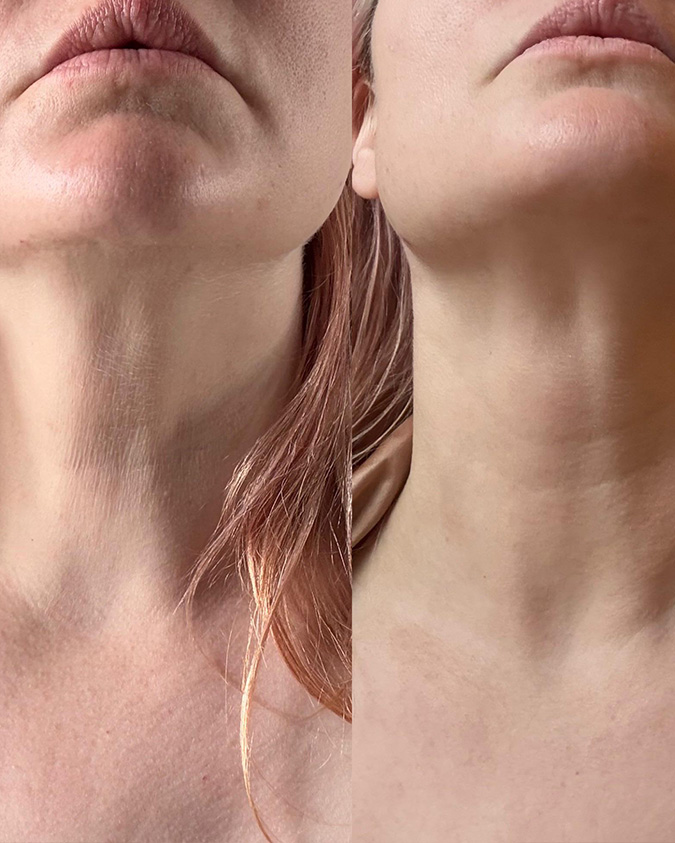 Przed i po zabiegu Tixel - przykład 11