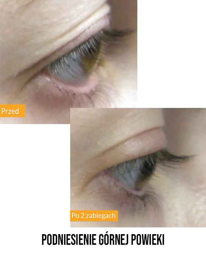 Przed i po zabiegu Tixel - przykład 2