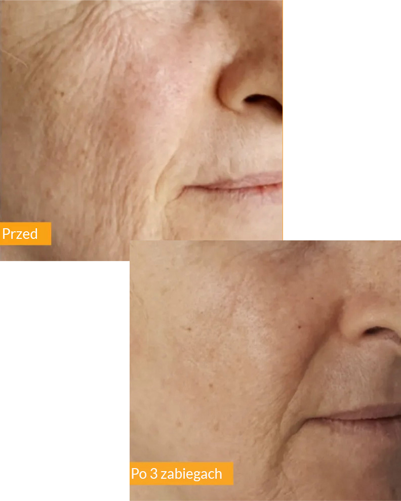 Przed i po zabiegu Tixel - przykład 3