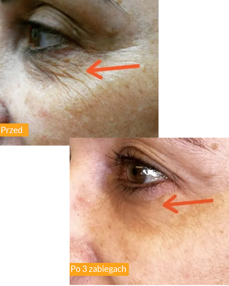 Przed i po zabiegu Tixel - przykład 5