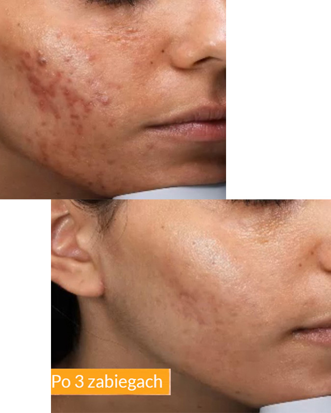 Przed i po zabiegu Tixel - przykład 6