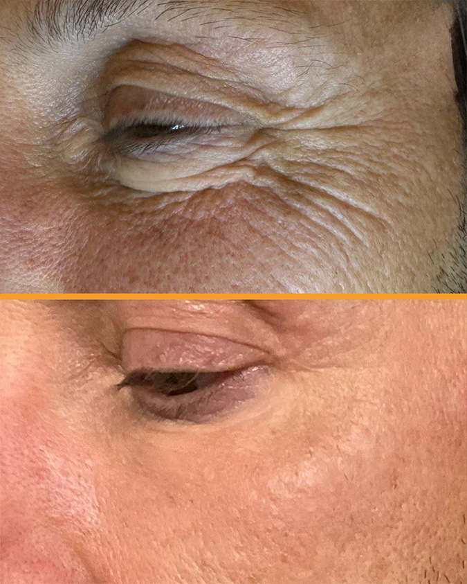 Przed i po zabiegu Tixel - przykład 8