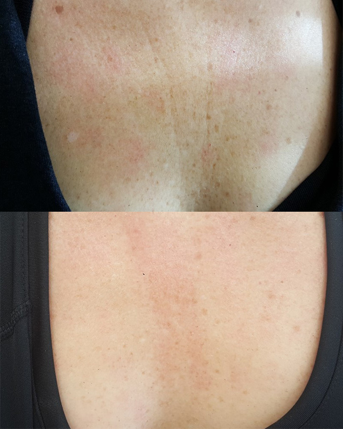 Przed i po zabiegu Tixel - przykład 9