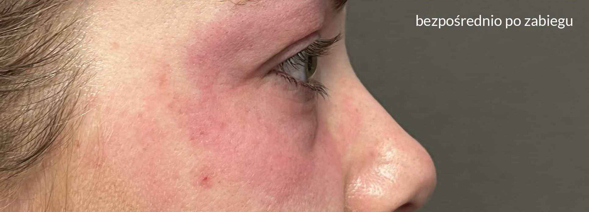 Skóra bezpośrednio po zabiegu Tixel - zaczerwienienie i obrzęk