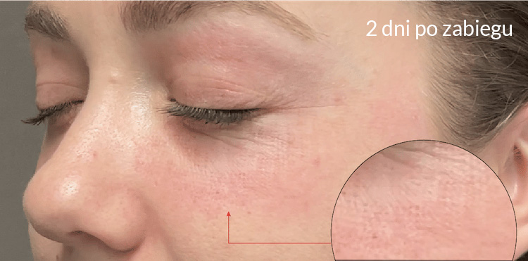 Skóra 2 dni po zabiegu Tixel - proces złuszczania mikro-skorupek